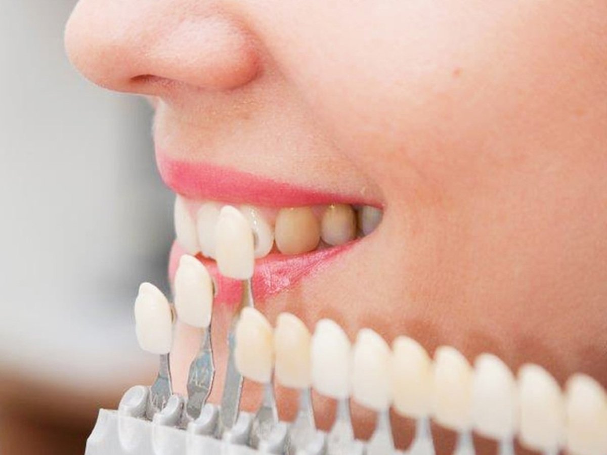 لبخندی زیبا با خدمات لمینت دندان دکتر هومن پاک نیت