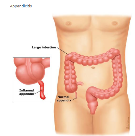 آپاندیسیت چیست؟ (درد شکم مرتبط با آپاندیس)