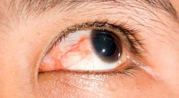 علائم خطر زخم قرنیه