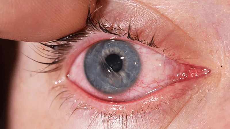 علائم خطر زخم قرنیه