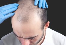 چند روز بعد از کاشت مو می‌توان سر کار رفت؟ راهنمای دوران نقاهت