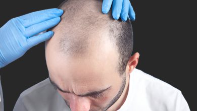 چند روز بعد از کاشت مو می‌توان سر کار رفت؟ راهنمای دوران نقاهت
